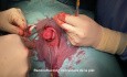 Circuncisión tratamiento de la fimosis y craurosis del prepucio. Phimosis circumcision.
