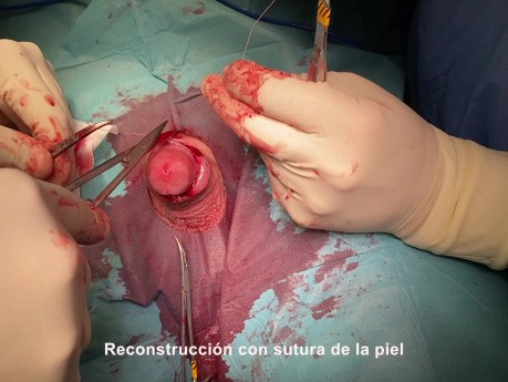 Circuncisión tratamiento de la fimosis y craurosis del prepucio. Phimosis circumcision.