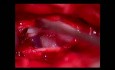Tumor espinal (neuroma) LWK2/3