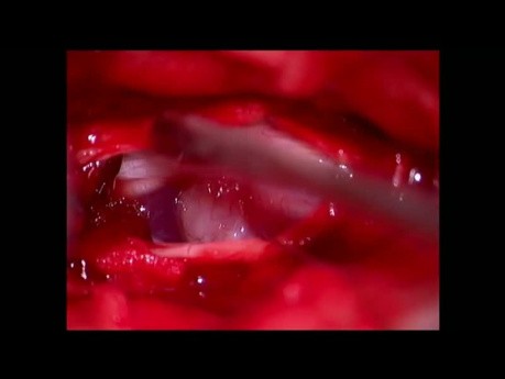 Tumor espinal (neuroma) LWK2/3