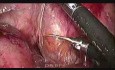 Inversión laparoscópica de Hartmann