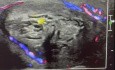Torsión testicular derecha avascular tras negligencia
