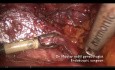 Lesión vascular durante histerectomía compleja