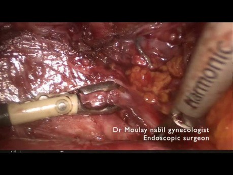 Lesión vascular durante histerectomía compleja
