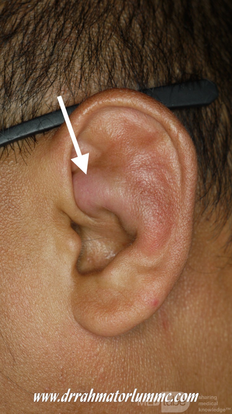 Seroma del pabellón auricular