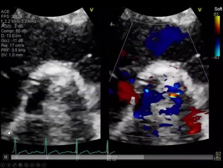 Evaluación ecocardiográfica de válvulas protésicas