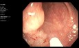 Tumor de extensión lateral del colon resecado mediante resección endoscópica de la mucosa (REM)