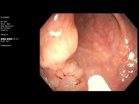 Tumor de extensión lateral del colon resecado mediante resección endoscópica de la mucosa (REM)