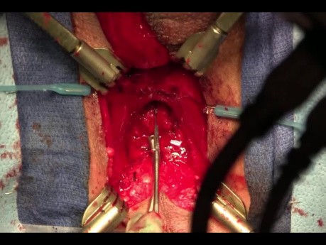 Uretroplastia posterior para lesión uretral por fractura pélvica