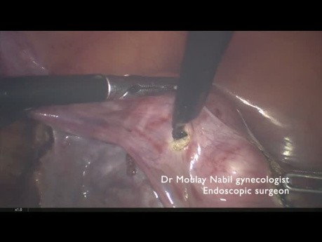 Polimiomectomía con control vascular transitorio