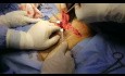 Hernia femoral: abordaje inguinal