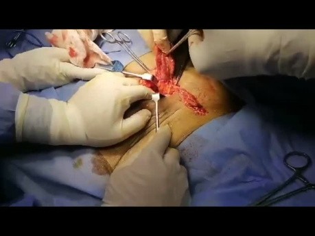 Hernia femoral: abordaje inguinal