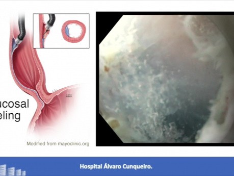 Miotomía endoscópica peroral (POEM) para el tratamiento de trastornos esofágicos hipercontráctiles
