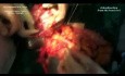 Tratamiento quirúrgico multifocal del sarcoma abdominal