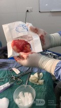 Craniectomía descompresiva en infarto maligno de la arteria cerebral media