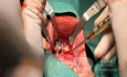 Osteotomía sagital del mentón