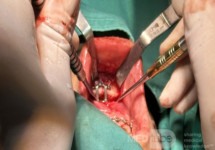 Osteotomía sagital del mentón