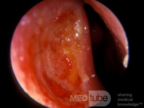 Úlcera del tabique nasal