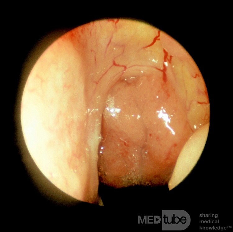 Adenoides moderadamente agrandadas