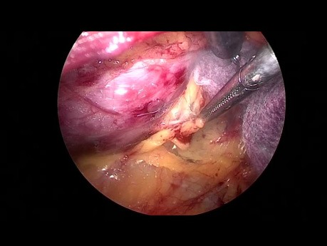 Decorticación del quiste renal hiliar mediante cirugía laparoscópica retroperitoneal