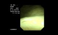 Tumor epidermoide atípico en la vejiga