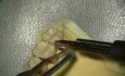 Symulacja endoskopowa debridementu (UL Palatal)