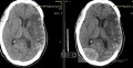 Craniectomía descompresiva en infarto maligno de la arteria cerebral media