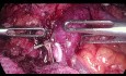 Pancreatectomía total laparoscópica para el tumor de cabeza pancreática