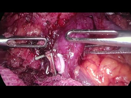 Pancreatectomía total laparoscópica para el tumor de cabeza pancreática