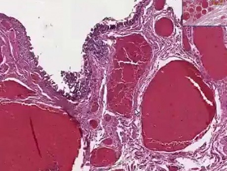 Histopatología de las hemorroides.