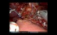 Pancreaticoduodenectomía robótica con antrectomía para el adenocarcinoma duodenal localmente avanzado