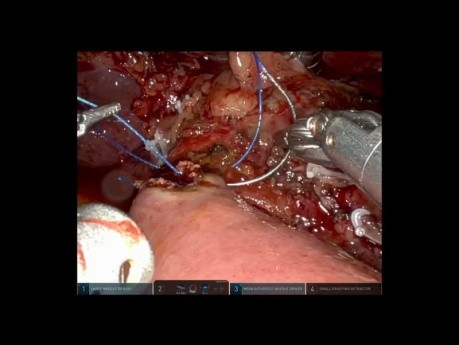 Pancreaticoduodenectomía robótica con antrectomía para el adenocarcinoma duodenal localmente avanzado