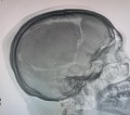 Craniectomía descompresiva en infarto maligno de la arteria cerebral media