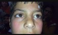 Algunos resultados del abordaje orbital de Singh a la ptosis de ptosis leve a grave
