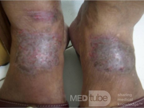 Neurodermatitis