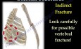 Tipos de fracturas esternales - video-clase