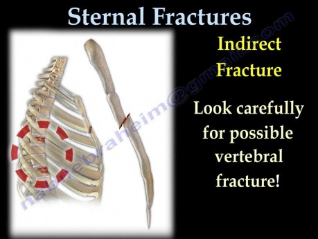 Tipos de fracturas esternales - video-clase