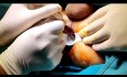 Fístula anal