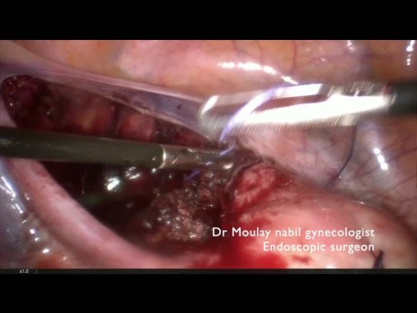 Control vascular transitorio y mioma ístmico cervical
