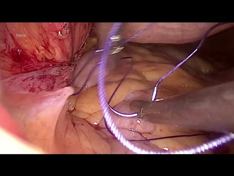 Suspensión de la vagina al ligamento rectouterino por el método vNOTES