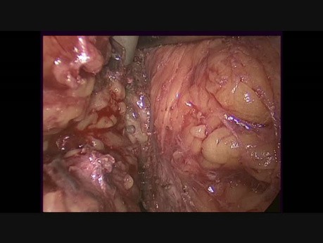 Resección anterior laparoscópica
