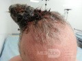Angiosarcoma del cuero cabelludo