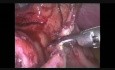 Tratamiento laparoscópico de la perforación endoscópica esofágica posdilatación
