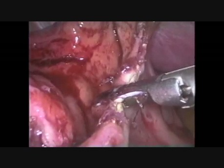 Tratamiento laparoscópico de la perforación endoscópica esofágica posdilatación