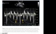 Evaluación ecocardiográfica y diagnóstico de la pericarditis constrictiva