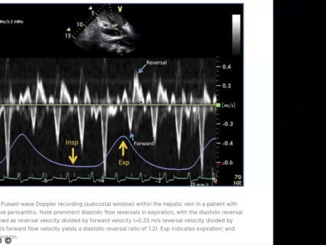 Evaluación ecocardiográfica y diagnóstico de la pericarditis constrictiva
