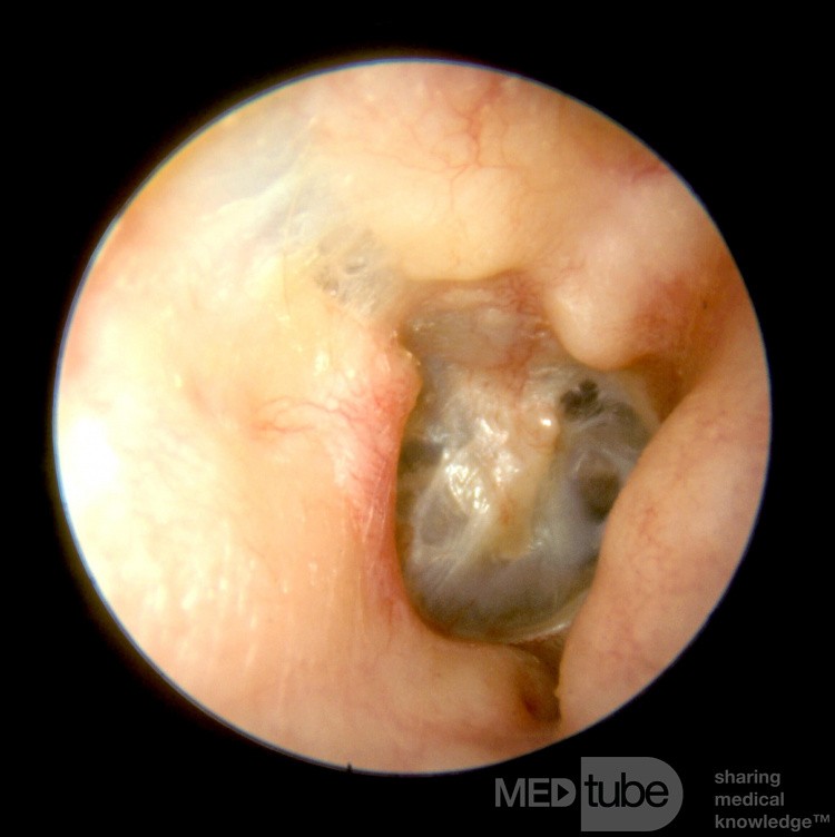 Fractura del hueso temporal [oído derecho]