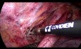 Esofagectomía toracoscópica