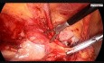 Demostración paso a paso de la cirugía de hernia inguinal