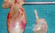 Pólipos nasales [muestra quirúrgica]